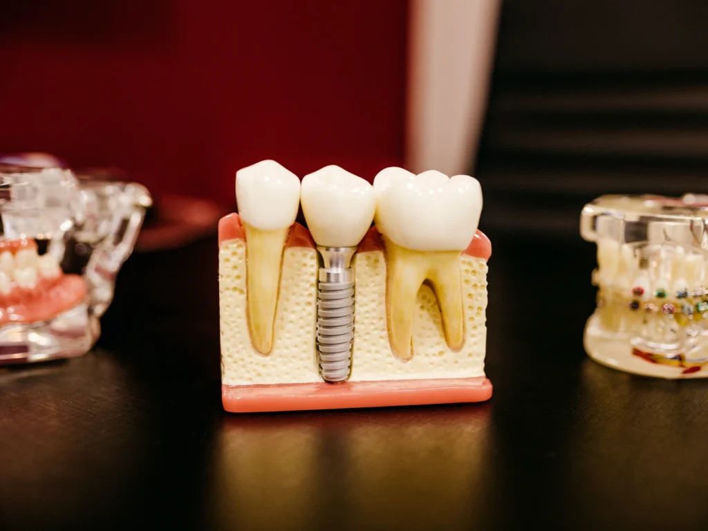 model of a single tooth dental implant | cost of dental implants in Austin, TX