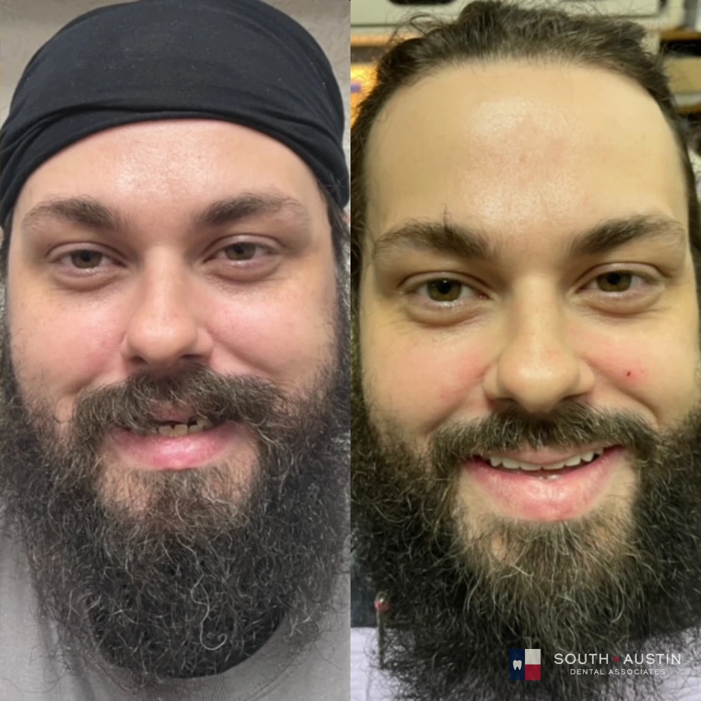 Before and after a smile makeover in Texas at South Austin Dental Associates by Dr. Evan Matthysse