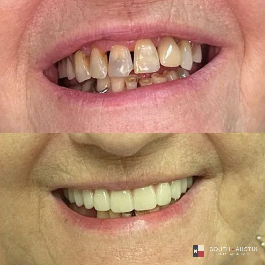 Before and after a smile makeover in Texas at South Austin Dental Associates by Dr. Evan Matthysse
