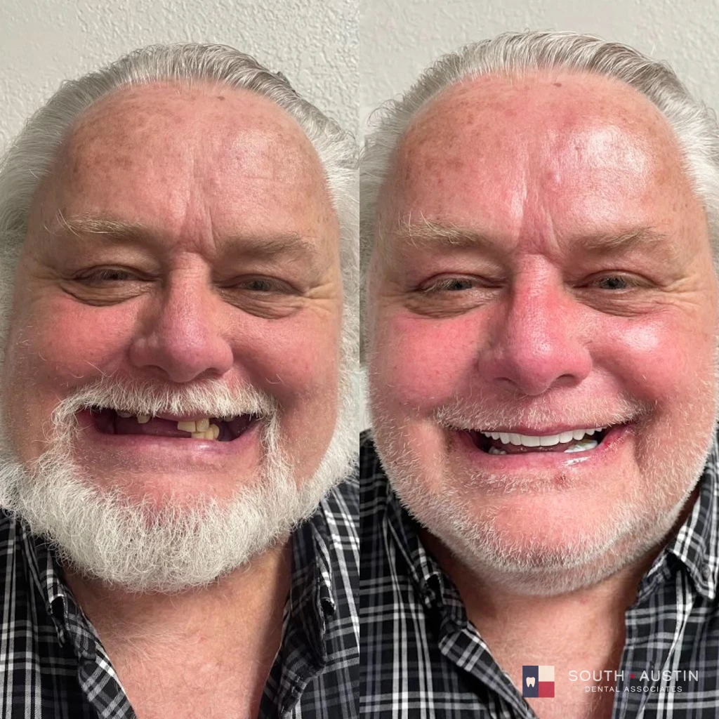 Before and after a smile makeover in Texas at South Austin Dental Associates by Dr. Evan Matthysse