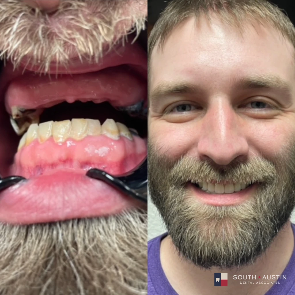 Before and after a smile makeover in Texas at South Austin Dental Associates by Dr. Evan Matthysse
