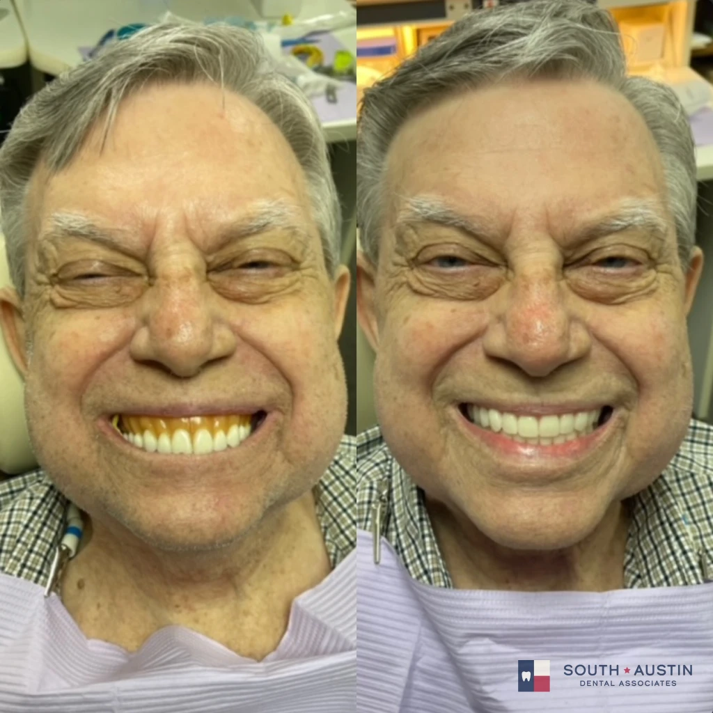 Before and after a smile makeover in Texas at South Austin Dental Associates by Dr. Evan Matthysse