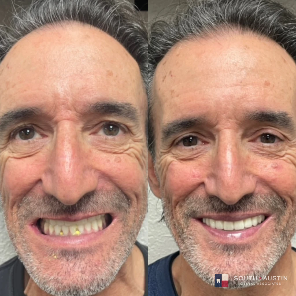 Before and after a smile makeover in Texas at South Austin Dental Associates by Dr. Evan Matthysse
