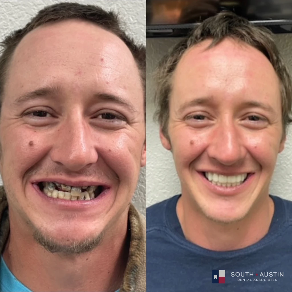 Before and after a smile makeover in Texas at South Austin Dental Associates by Dr. Evan Matthysse