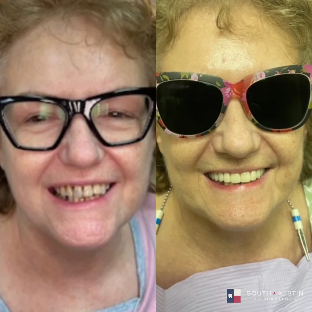 Before and after a smile makeover in Texas at South Austin Dental Associates by Dr. Evan Matthysse
