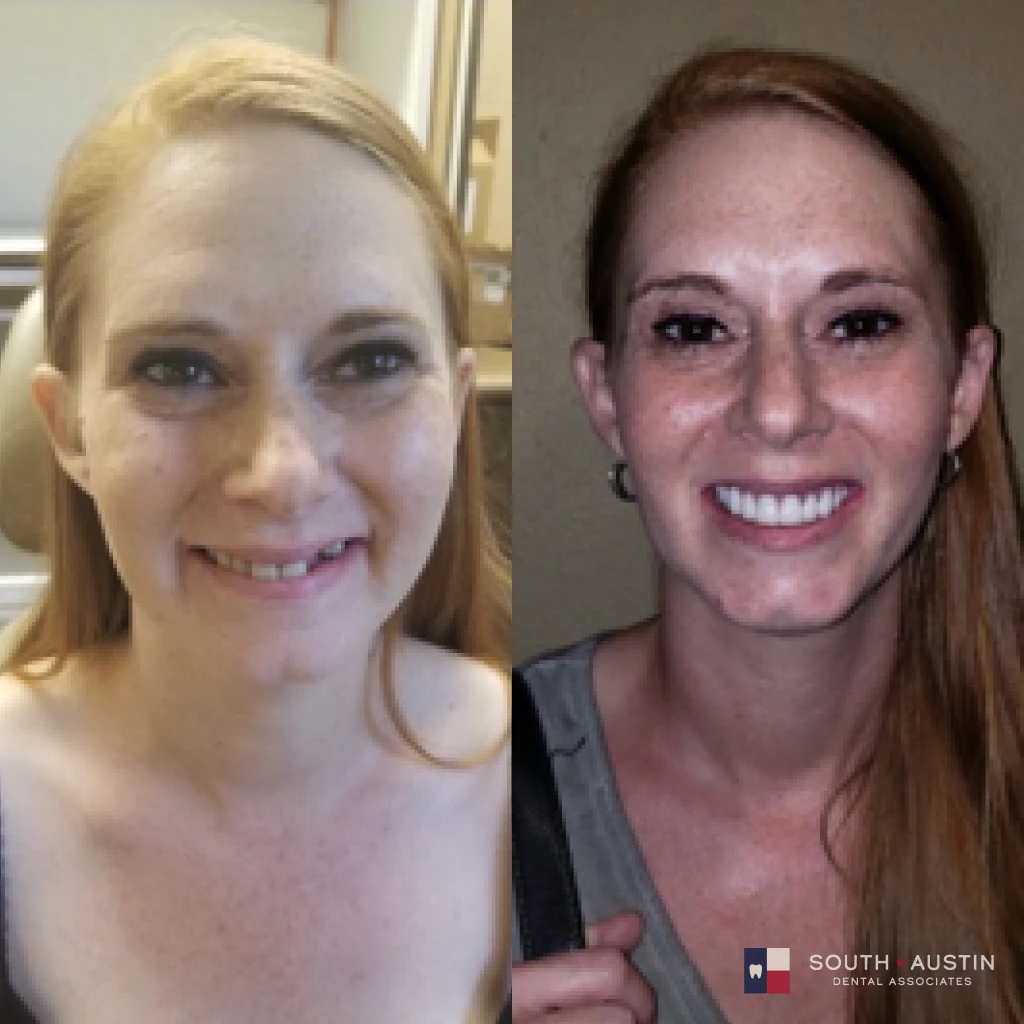 Before and after a smile makeover in Texas at South Austin Dental Associates by Dr. Evan Matthysse