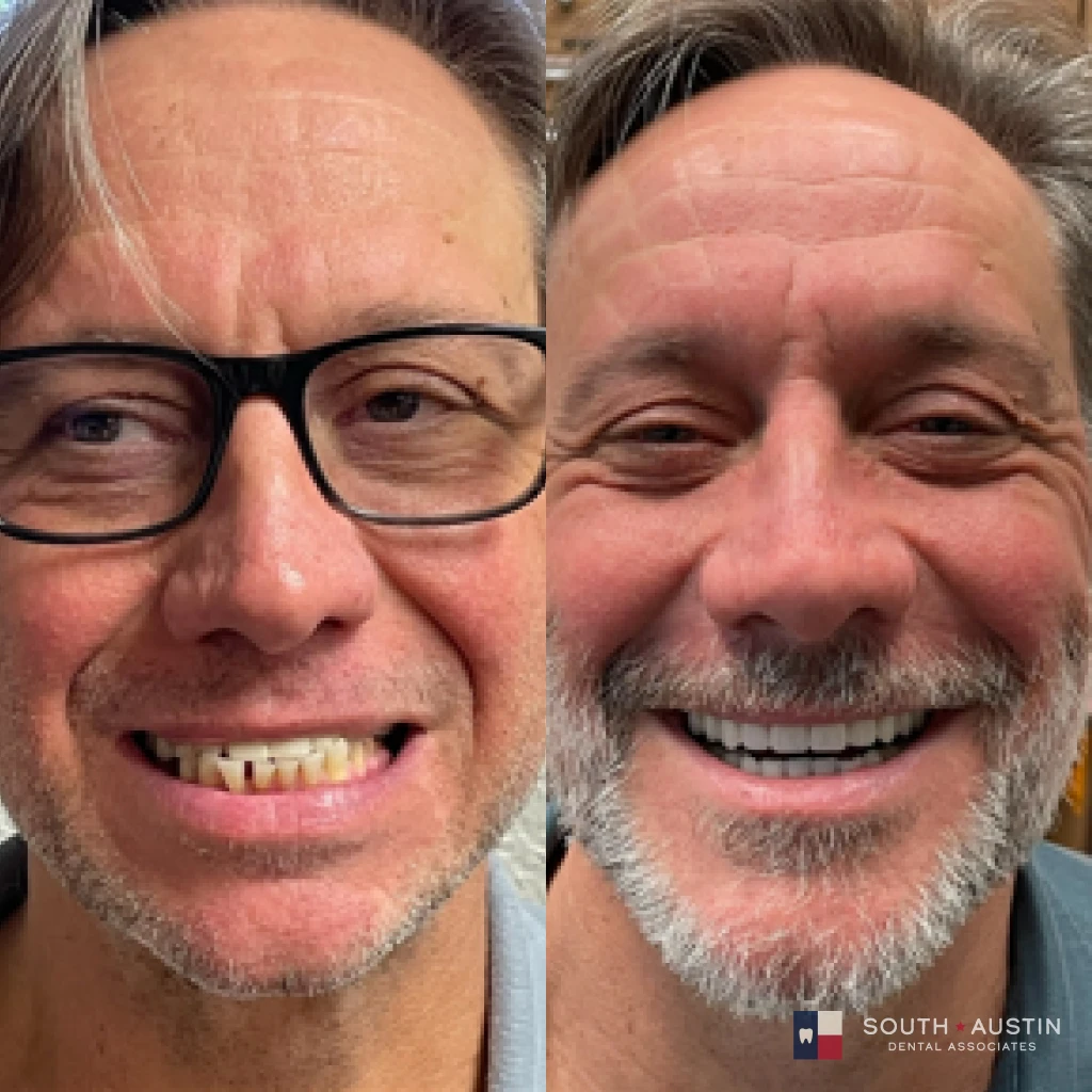 Before and after a smile makeover in Texas at South Austin Dental Associates by Dr. Evan Matthysse