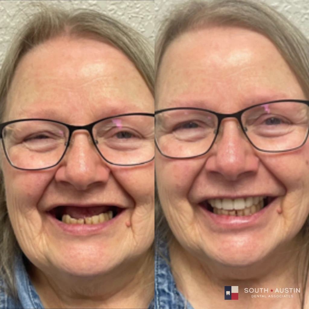 Before and after a smile makeover in Texas at South Austin Dental Associates by Dr. Evan Matthysse
