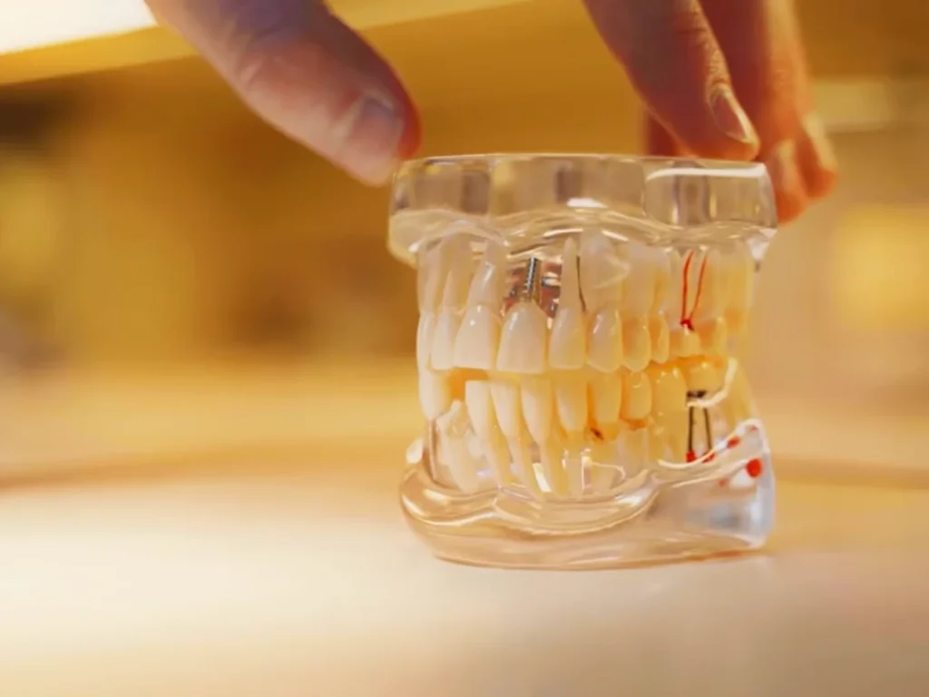 South Austin Dental Associates dental Implant model in Austin, TX