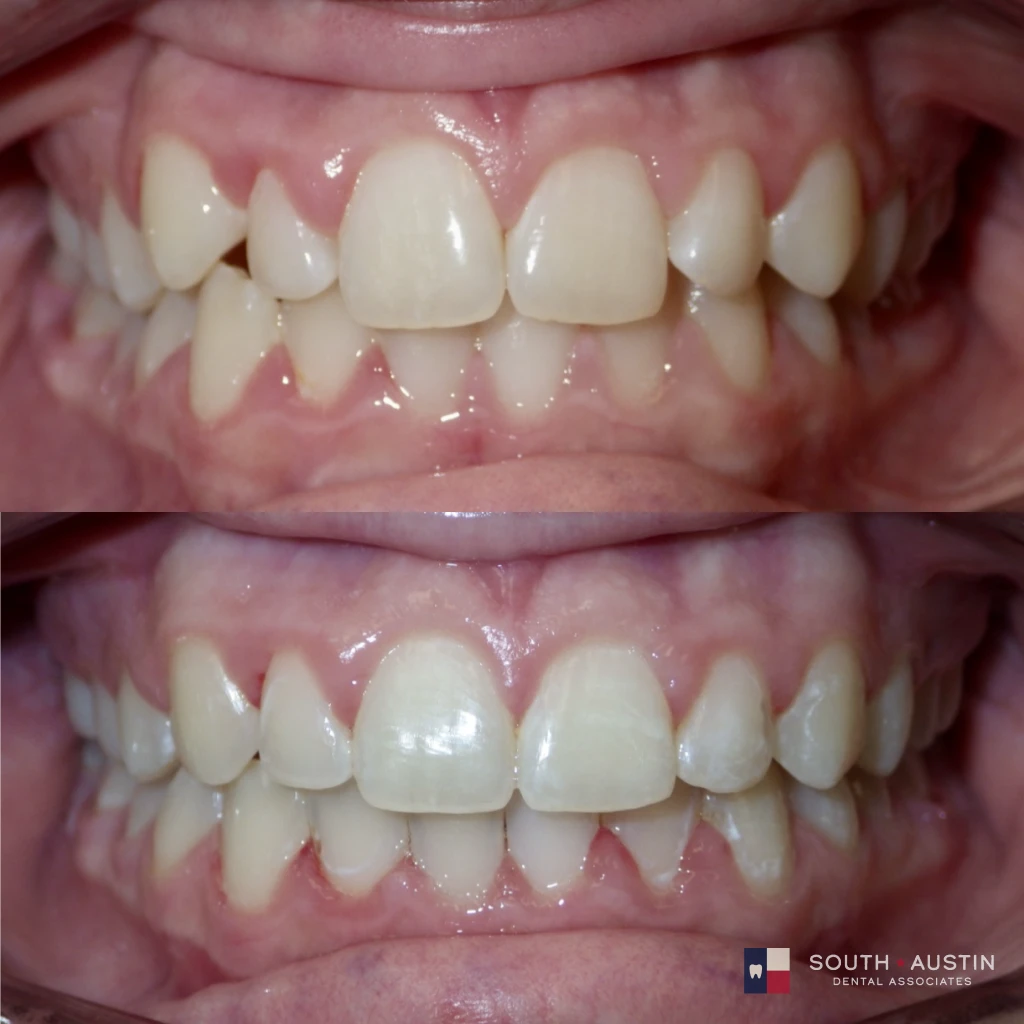 braces before and after at South Austin Dental Associates | orthodontic treatment in Austin, TX