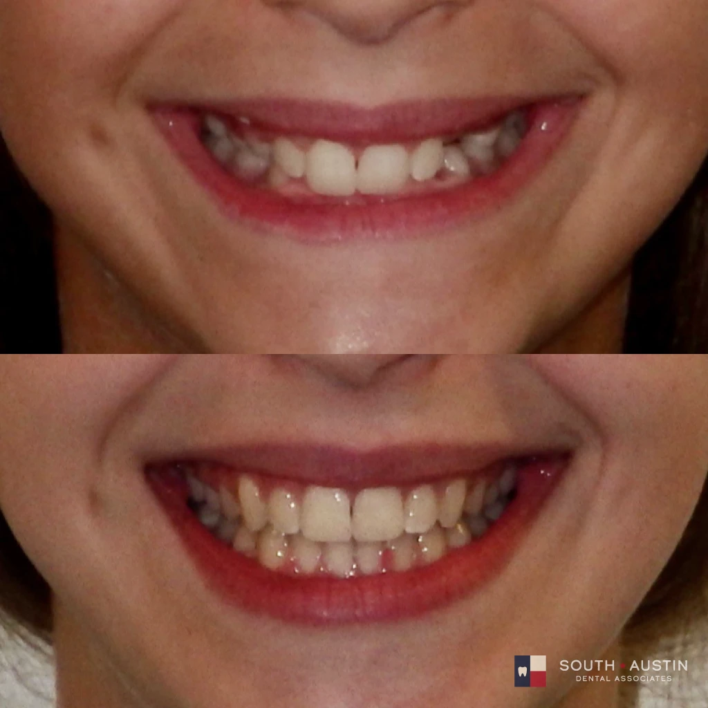 braces before and after at South Austin Dental Associates | orthodontic treatment in Austin, TX