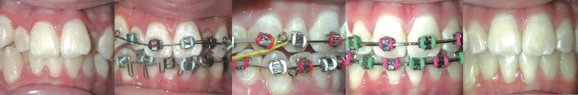 image of braces before and after results | Expert orthodontic treatment in Austin, TX